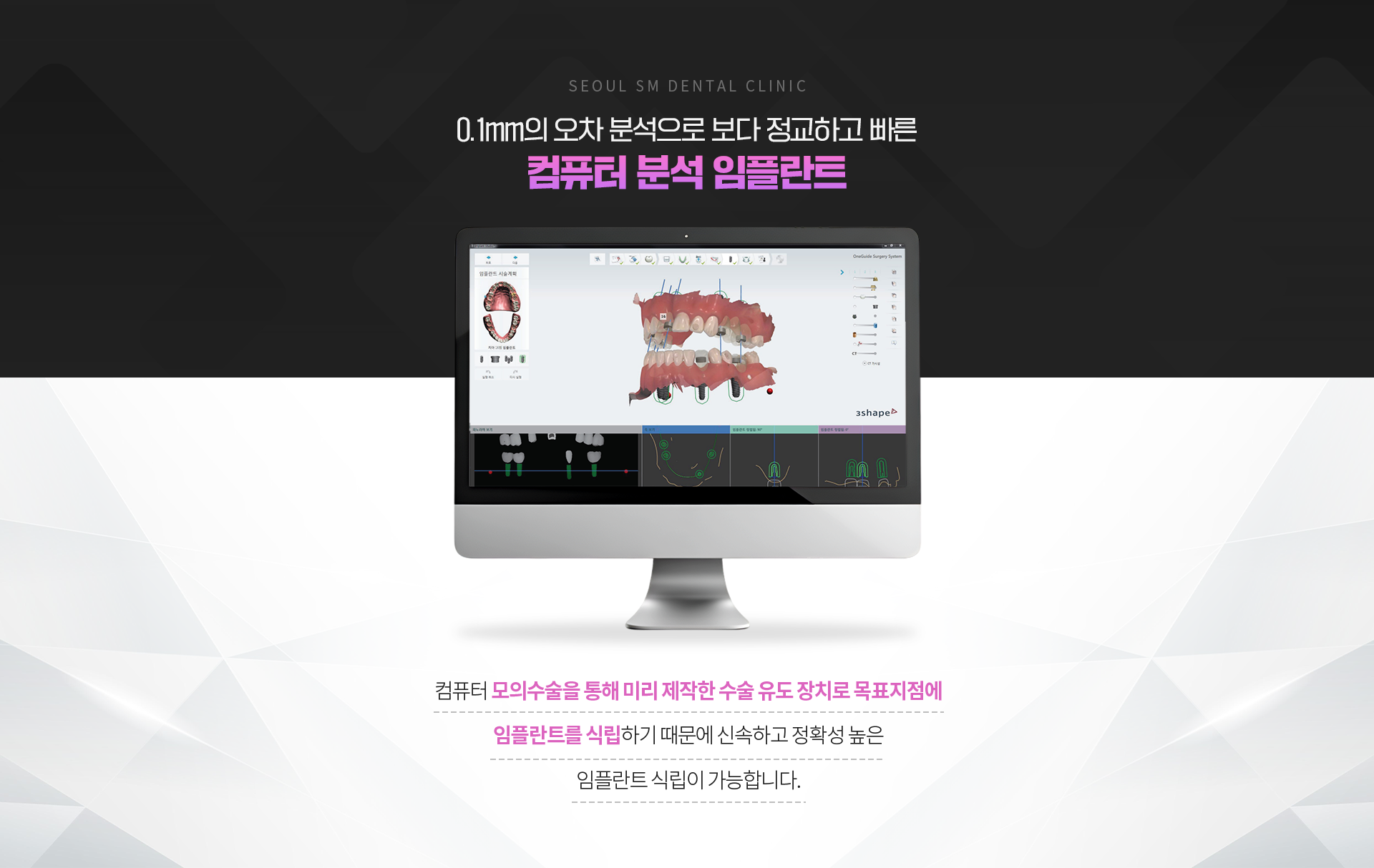 0.1mm의-오차분석으로-보다-정교하고-빠른-네비게이션-임플란트-컴퓨터-모의수술을통해-미리-제작한-수술유도장치로-목표지점에-임플란트를-식립-신속-정확