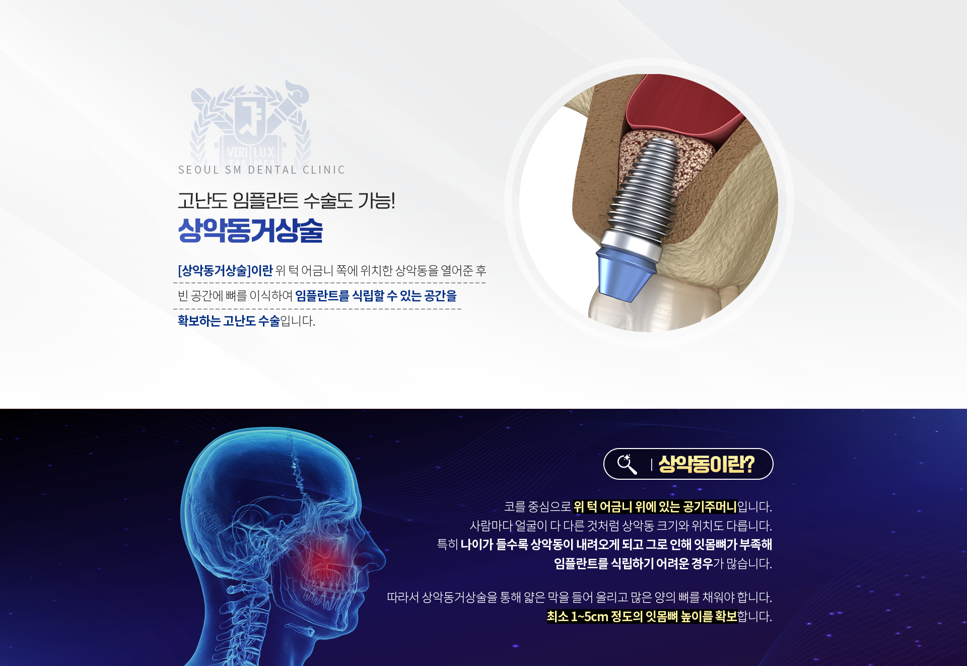 상악동거상술-어금니쪽에-위치한-상악동을-열어준-후-빈-공간에-뼈를-이식하여-임플란트를-식립할-수-있는-공간을-확보하는-고난도-수술입니다