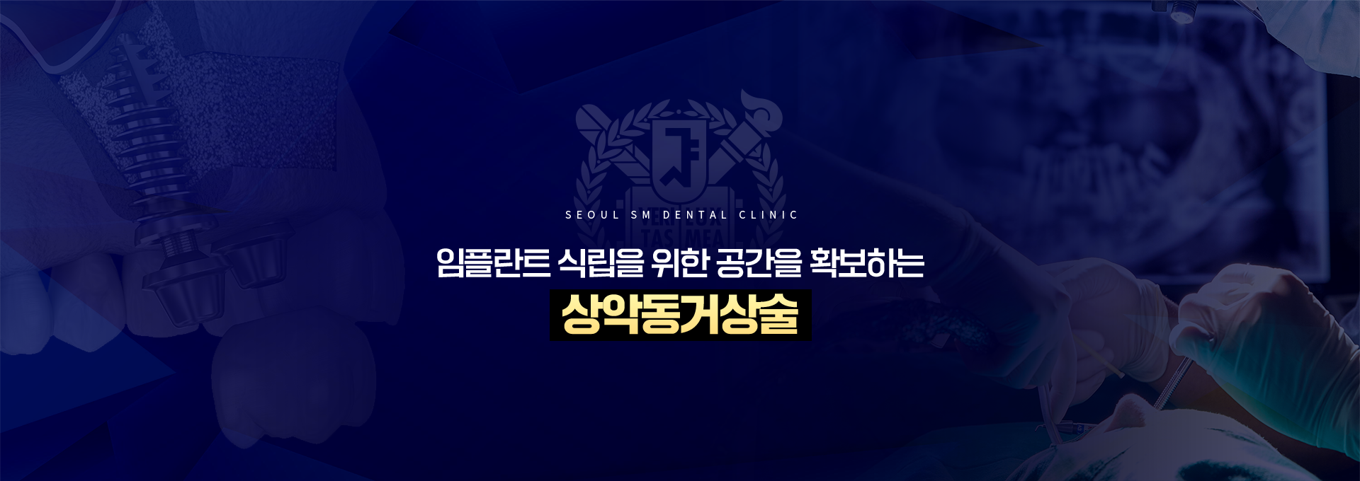 임플란트-식립을-위한-공간을-확보하는-상악동거상술