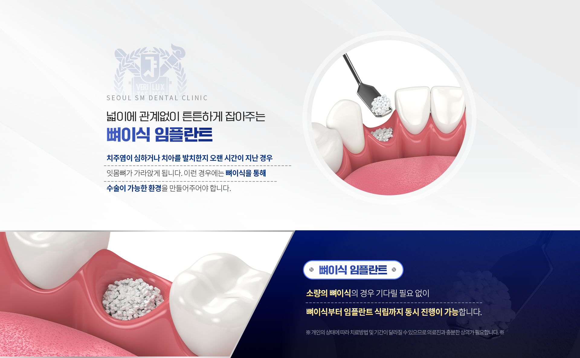 넓이에-관계없이-튼튼하게-잡아주는-뼈이식임플란트