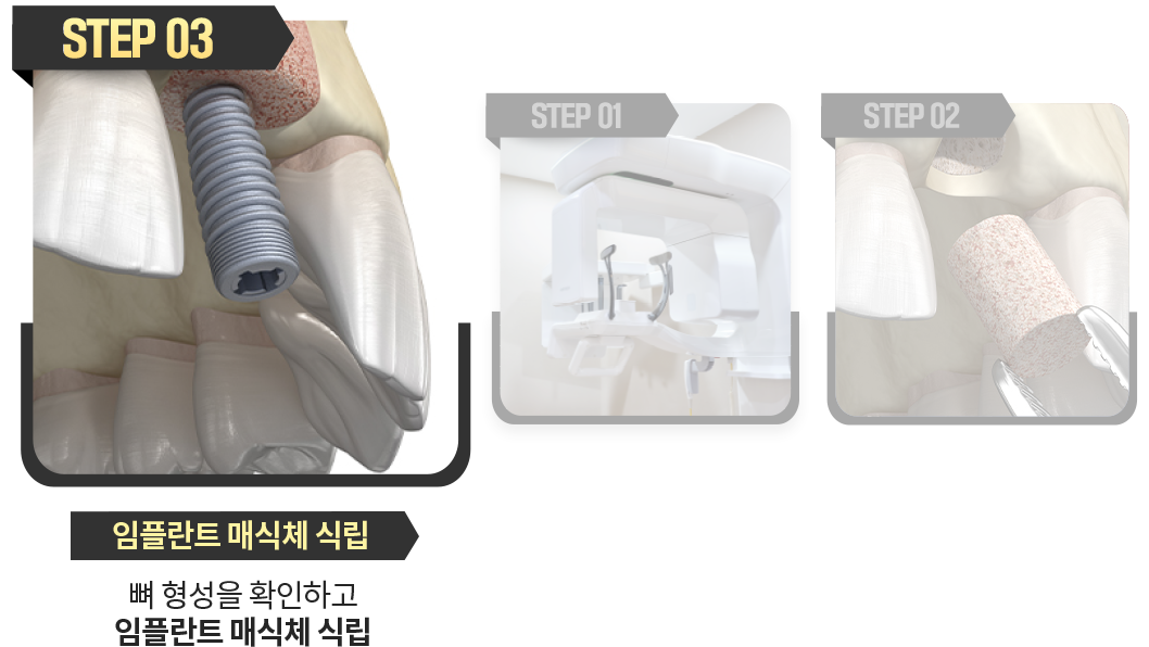 임플란트-매식체-식립
