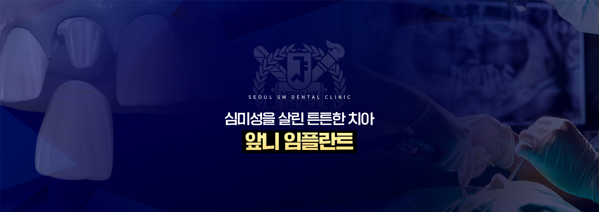 심미성을-살린-튼튼한-치아-앞니임플란트