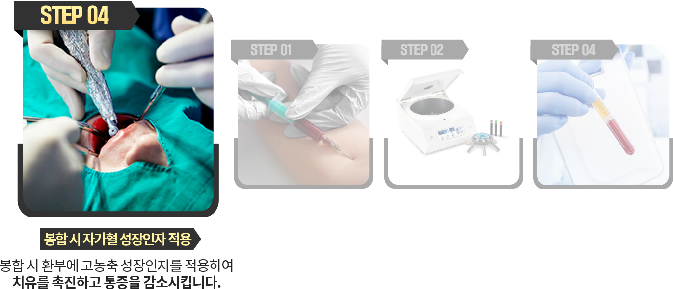 봉합-시-자가혈-성장인자-적용