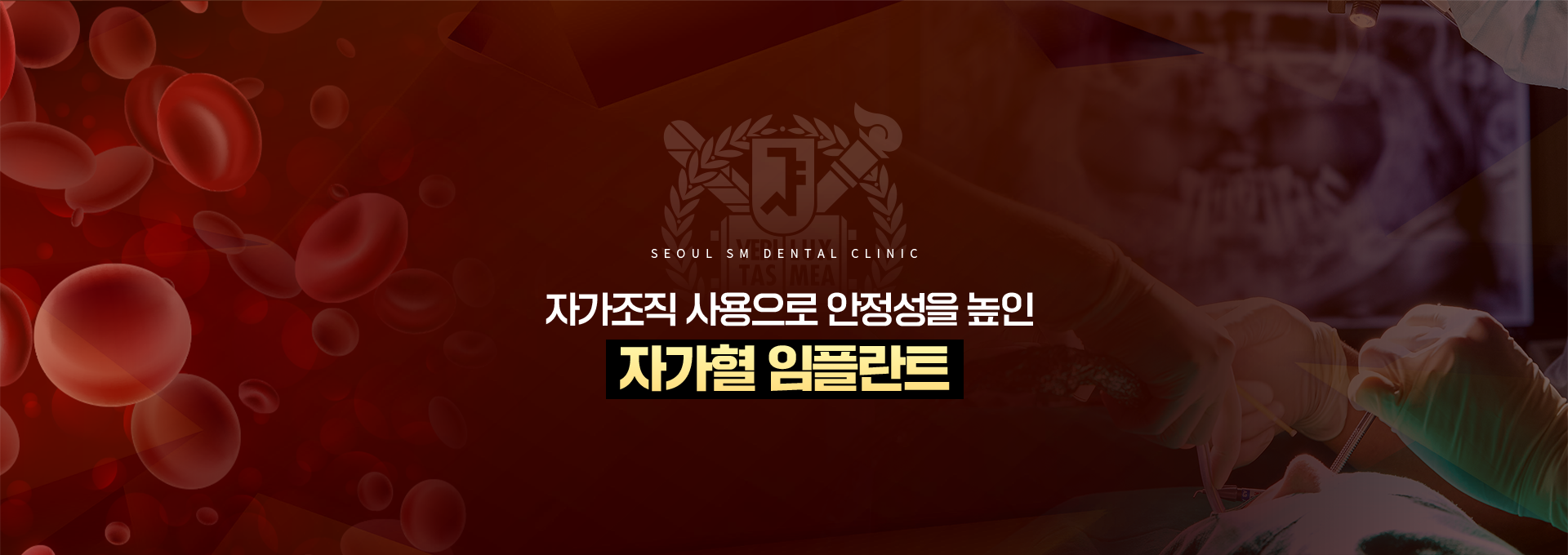 자가조직-사용으로-안정성을-높인-자가혈이식임플란트