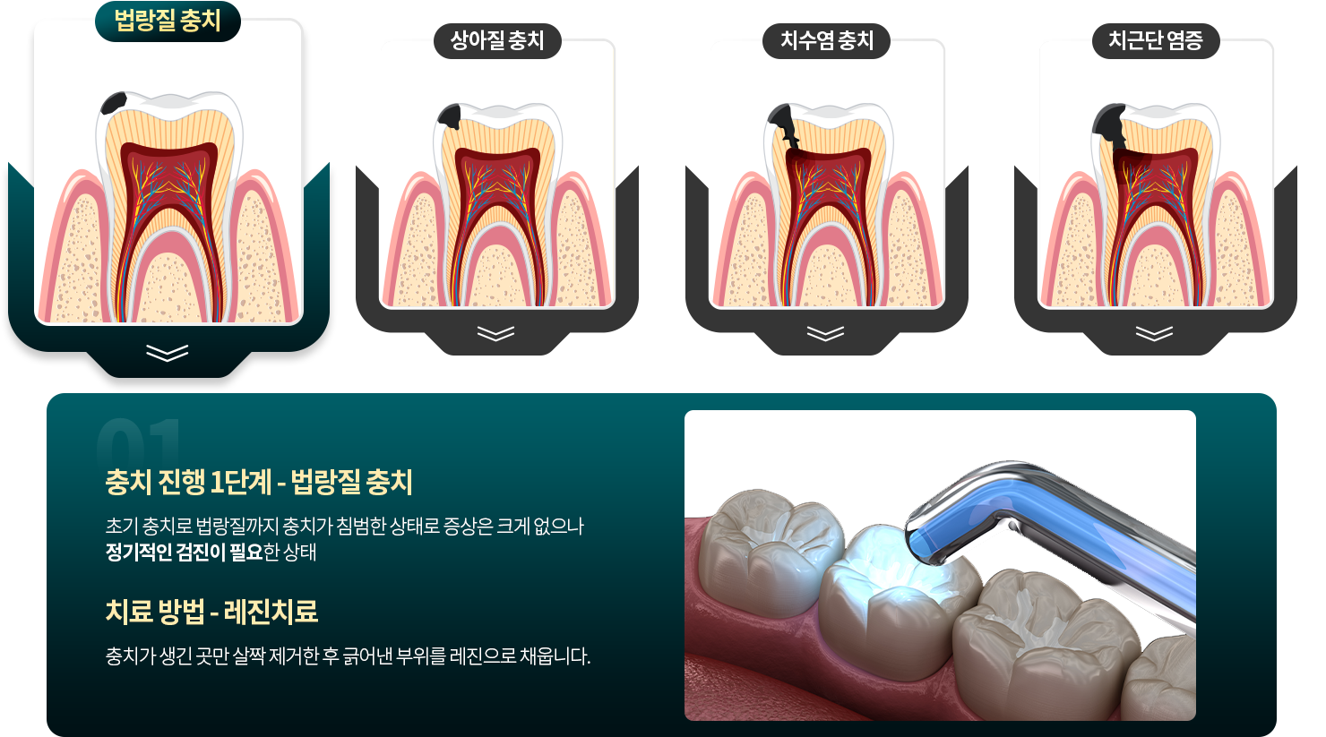 법랑질 충치