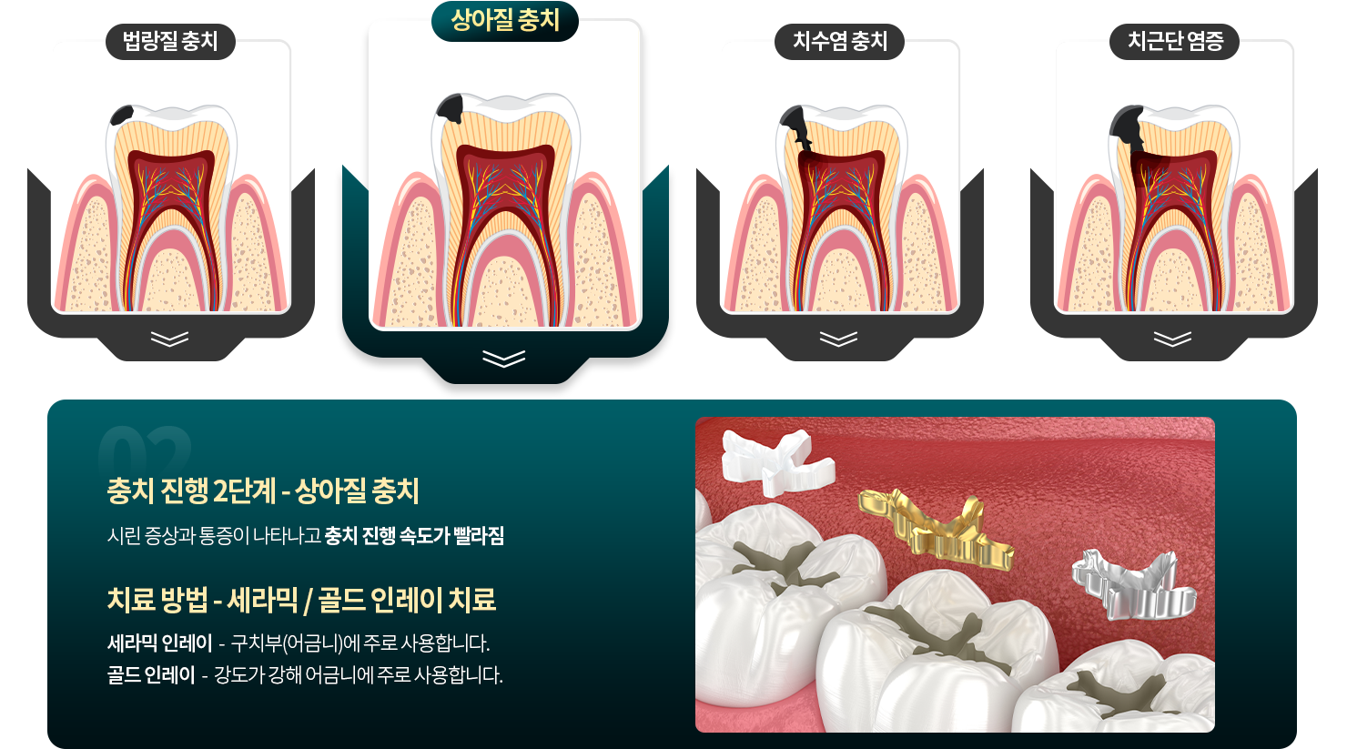 상아질 충치