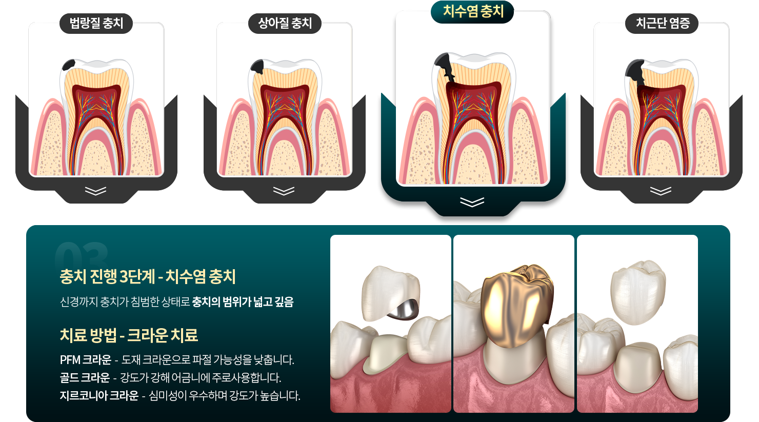 치수염 충치