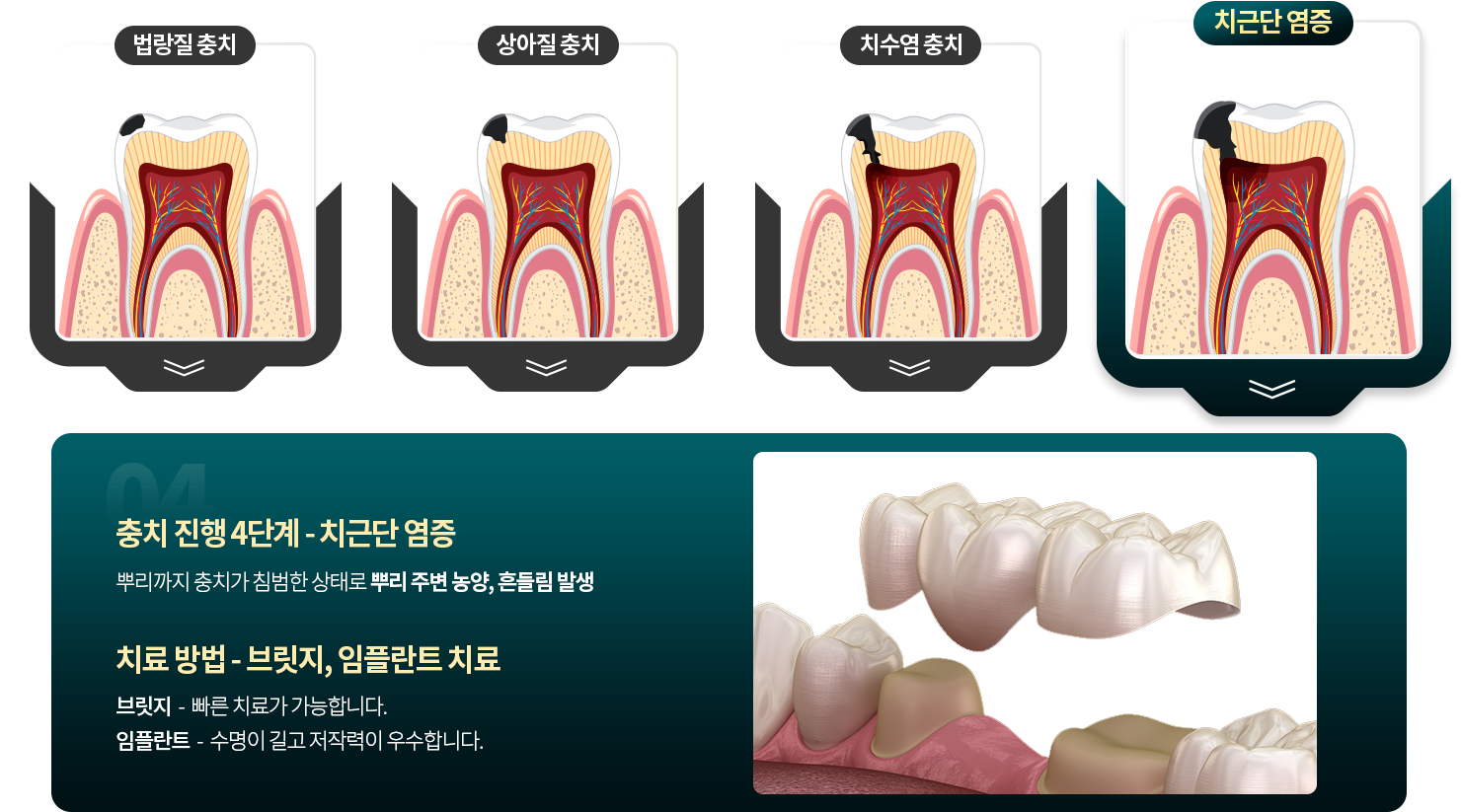 치근단 충치