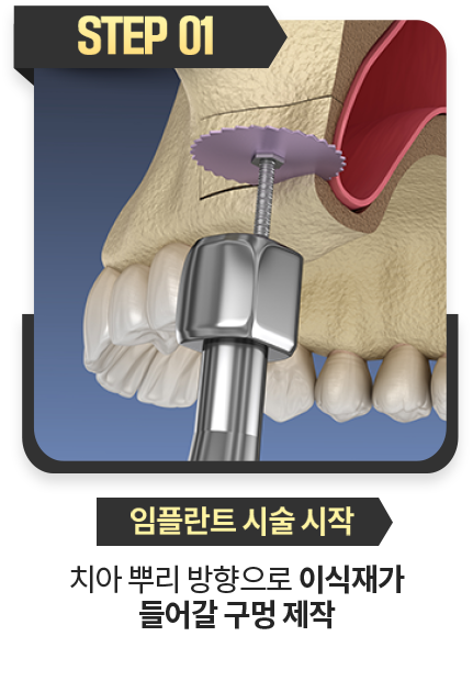 임플란트-시술-시작-치아뿌리-방향으로-이식재가-들어갈-구멍-제작