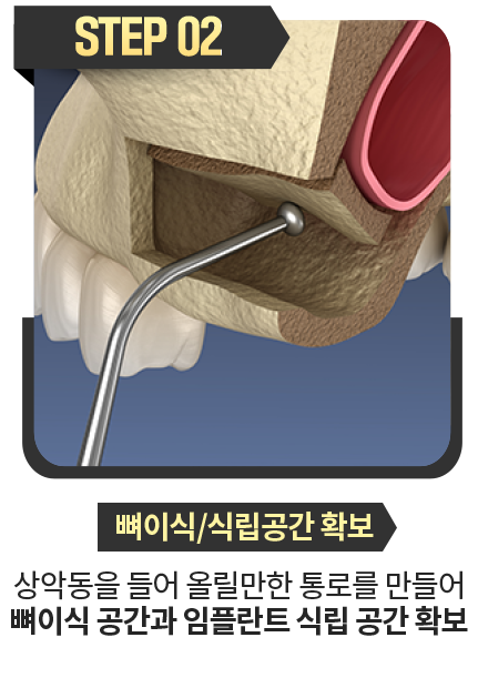 뼈이식-식립공간-확보-상악동을-들어-올릴만한-통로를-만들어-뼈이식-공간과-임플란트-식립공간-확보