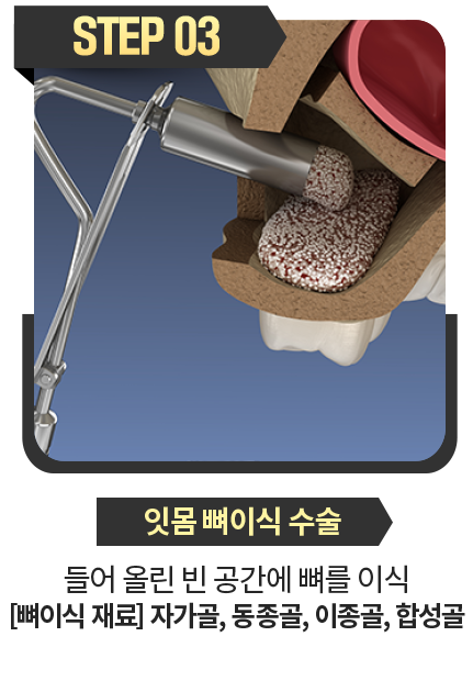 잇몸-뼈이식-수술-들어올린-빈공간에-뼈를-이식-뼈이식-재료-자가솔-인공뼈-합성골
