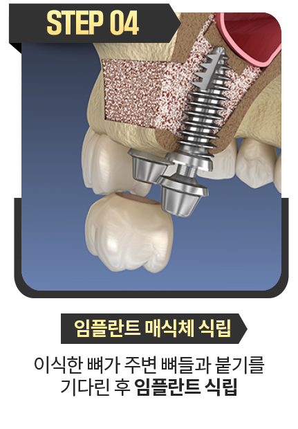 임플란트-매식체-식립-이식한-뼈가-주변-뼈들과-붙기를-기다린-후-임플란트-식립