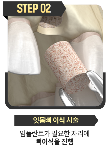 잇몸뼈-이식-시술