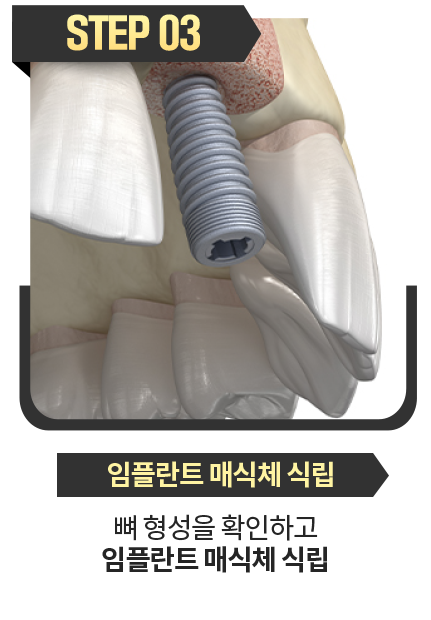 임플란트-매식체-식립