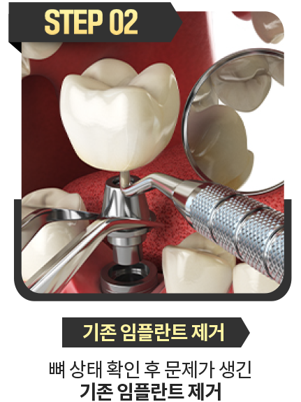 기존-임플란트-제거