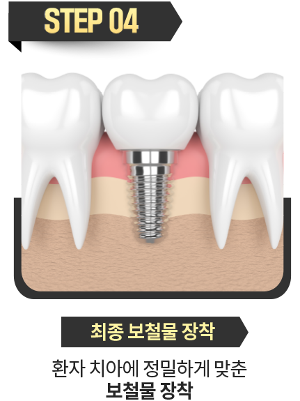 최종-보철물-장착