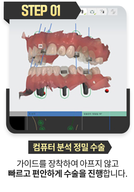 네비게이션-정밀-수술