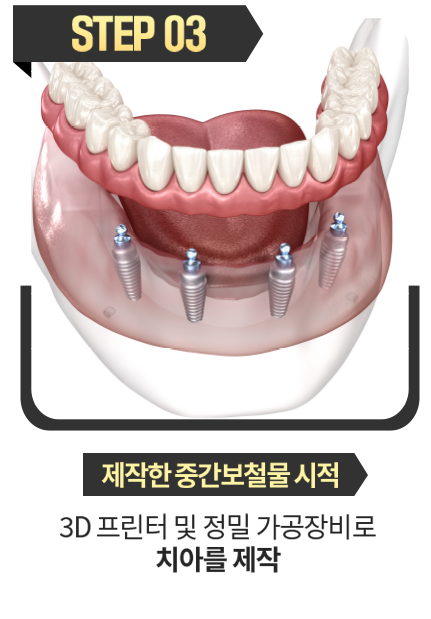 제작한-중간보철물-시적