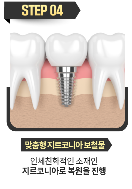 맞춤형-지르코니아-보철물