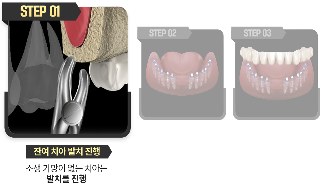 잔여-치아-발치-진행